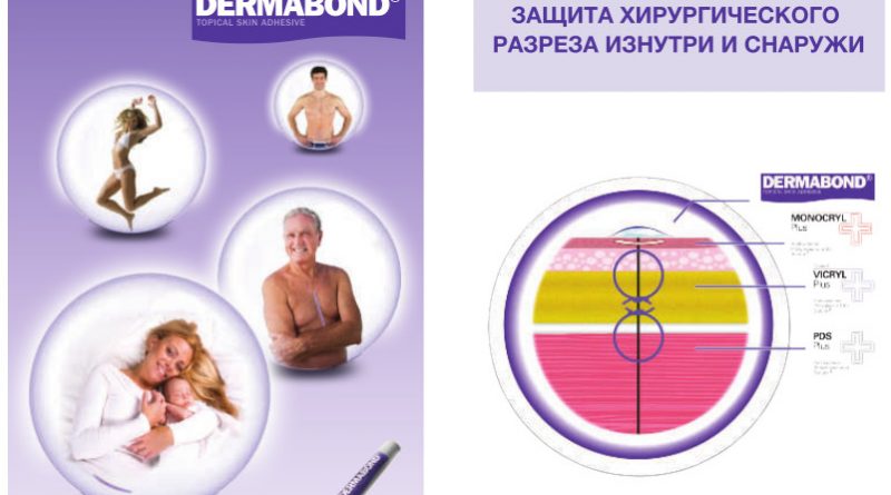 Кожный клей Dermabond Позволяет пациенту принять душ сразу по окончании операции